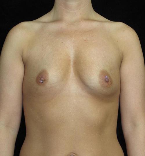 Breast Augmentation Patient Photo - Case 137 - before view-