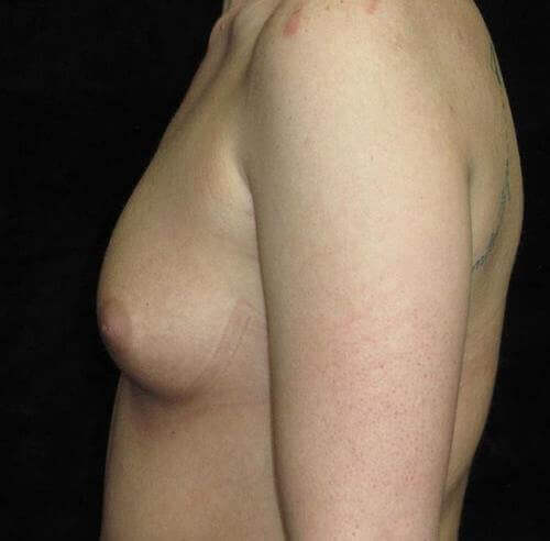 Breast Augmentation Patient Photo - Case 136 - before view-1