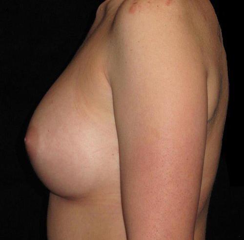 Breast Augmentation Patient Photo - Case 136 - after view-1