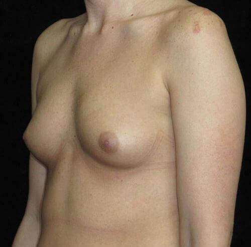 Breast Augmentation Patient Photo - Case 136 - before view-0