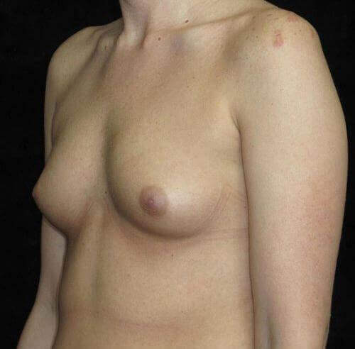 Breast Augmentation Patient Photo - Case 136 - before view-