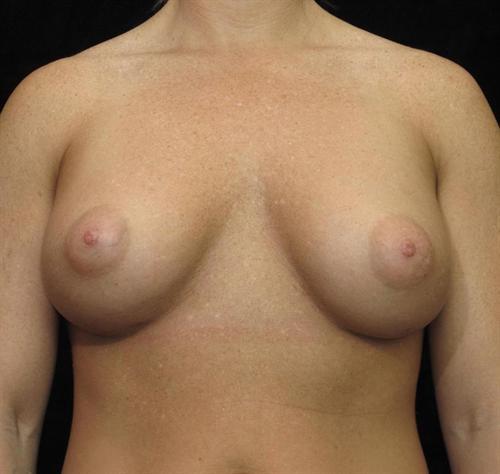 Breast Augmentation Patient Photo - Case 99 - after view-0