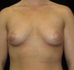 Breast Augmentation - Case 99 - Before