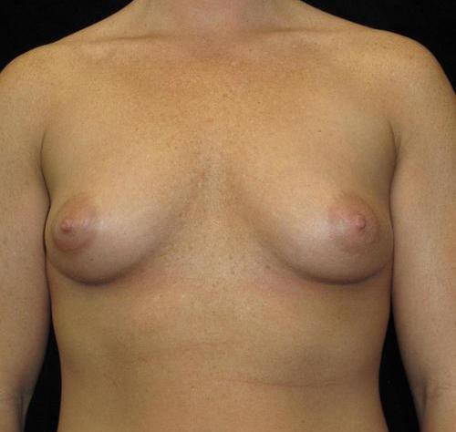 Breast Augmentation Patient Photo - Case 99 - before view-0