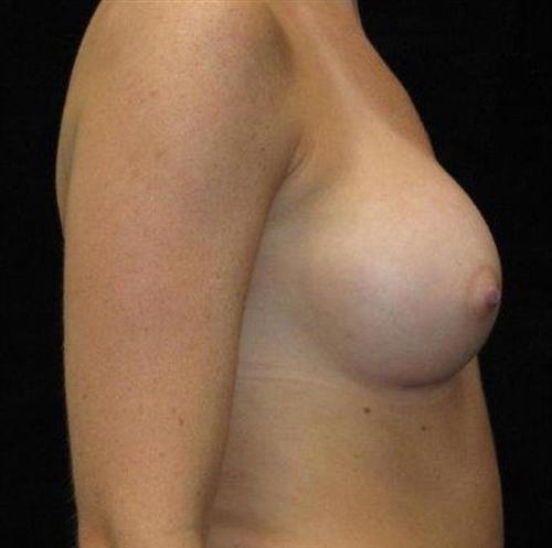 Breast Asymmetry Patient Photo - Case 94 - after view-1