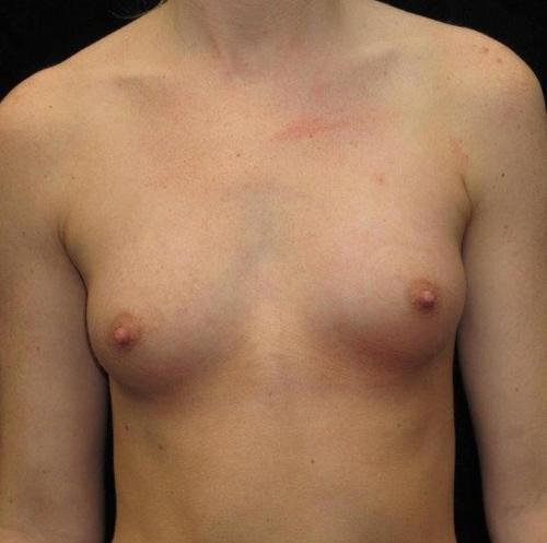 Breast Asymmetry Patient Photo - Case 94 - before view-