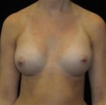 Breast Asymmetry - Case 94 - After