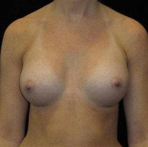 Breast Asymmetry Patient Photo - Case 94 - after view