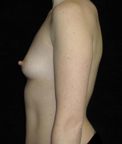 Breast Augmentation Patient Photo - Case 152 - before view-1