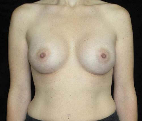 Breast Augmentation Patient Photo - Case 152 - after view-0