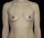 Breast Augmentation - Case 152 - Before