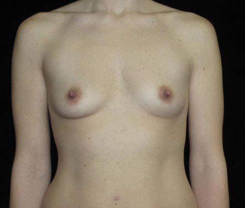 Breast Augmentation Patient Photo - Case 152 - before view-