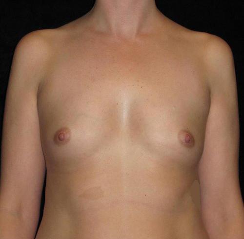 Breast Augmentation Patient Photo - Case 135 - before view-