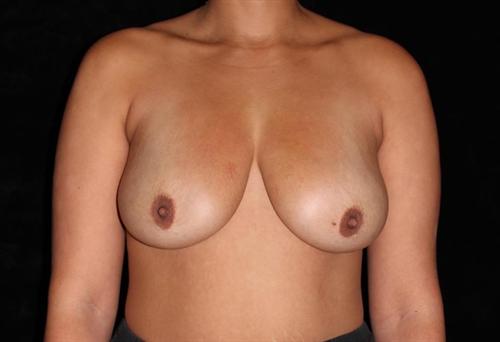 Breast Lift Patient Photo - Case 169 - before view-