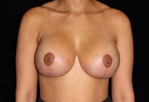 Breast Lift Patient Photo - Case 169 - after view