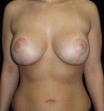Breast Lift - Case 119 - After