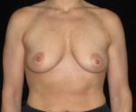 Breast Lift - Case 155 - Before
