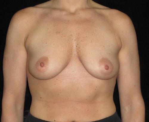 Breast Lift Patient Photo - Case 155 - before view-