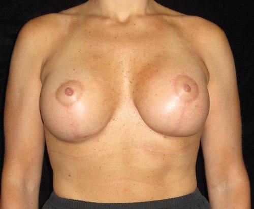 Breast Lift Patient Photo - Case 155 - after view-0