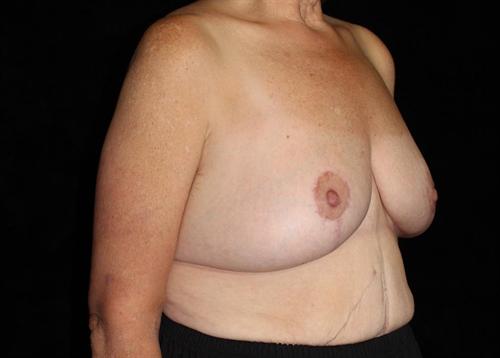Breast Lift Patient Photo - Case 172 - after view-1