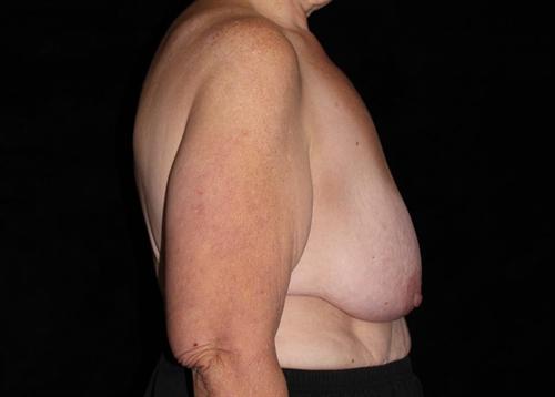 Breast Lift Patient Photo - Case 172 - before view-2