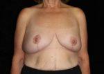 Breast Lift - Case 172 - After
