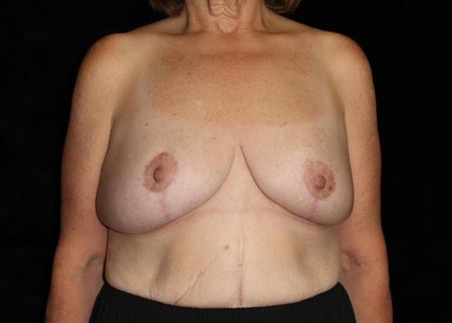 Breast Lift Patient Photo - Case 172 - after view-0