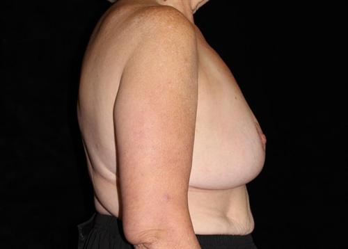 Breast Lift Patient Photo - Case 172 - after view-2