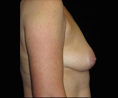 Breast Lift Patient Photo - Case 114 - before view-1