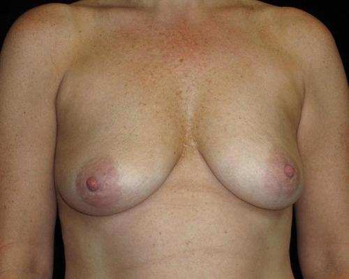 Breast Lift Patient Photo - Case 114 - before view-