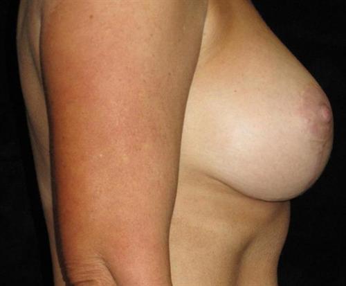 Breast Lift Patient Photo - Case 114 - after view-1