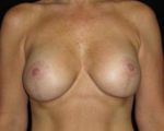 Breast Lift - Case 114 - After