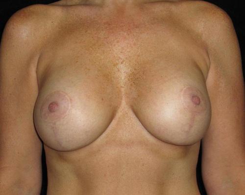 Breast Lift Patient Photo - Case 114 - after view