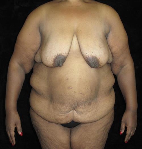 Body Lift Patient Photo - Case 225 - before view-