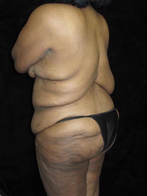 Body Lift Patient Photo - Case 225 - before view-2