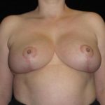 Breast Lift - Case 120 - After