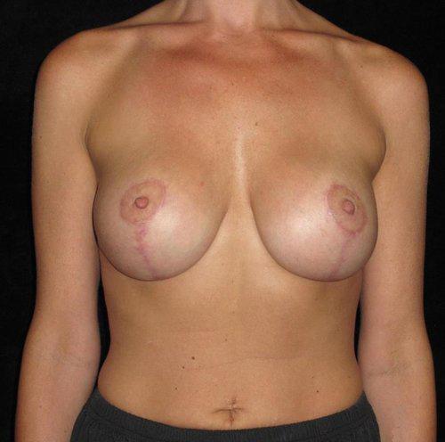 Breast Lift Patient Photo - Case 154 - after view