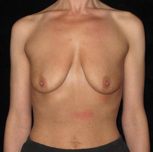 Breast Lift Patient Photo - Case 154 - before view-