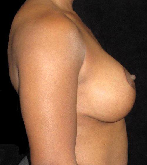 Breast Augmentation Patient Photo - Case 122 - after view-1