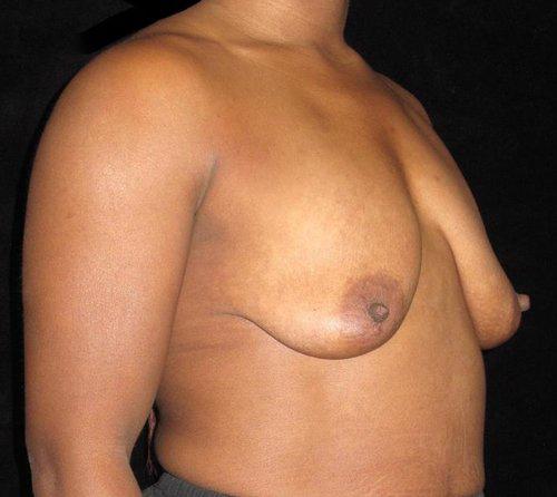 Breast Augmentation Patient Photo - Case 122 - before view-0