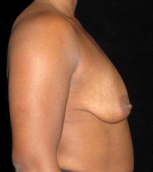 Breast Augmentation Patient Photo - Case 122 - before view-1