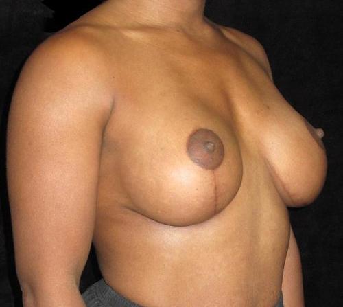 Breast Augmentation Patient Photo - Case 122 - after view