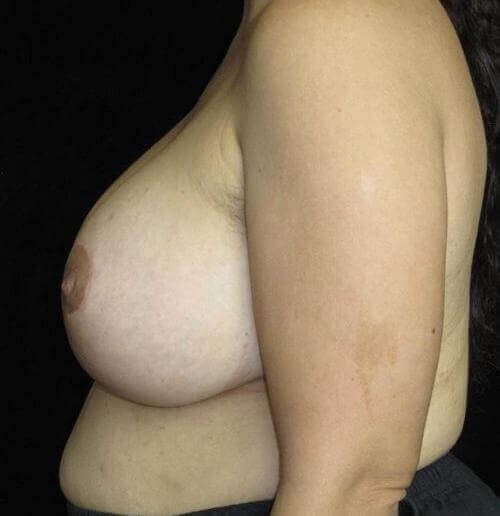 Breast Augmentation Patient Photo - Case 139 - after view-1