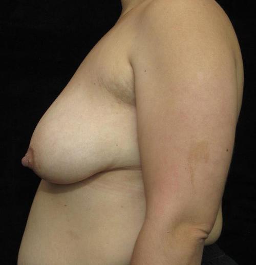 Breast Augmentation Patient Photo - Case 139 - before view-1