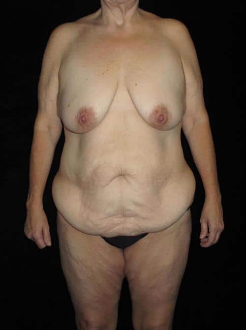 Body Lift Patient Photo - Case 188 - before view-