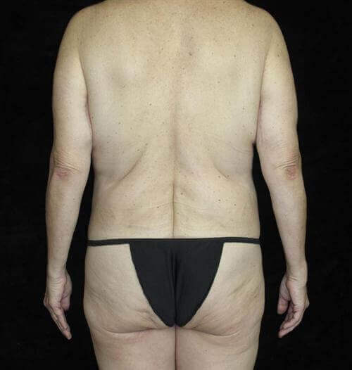 Body Lift Patient Photo - Case 188 - after view-3