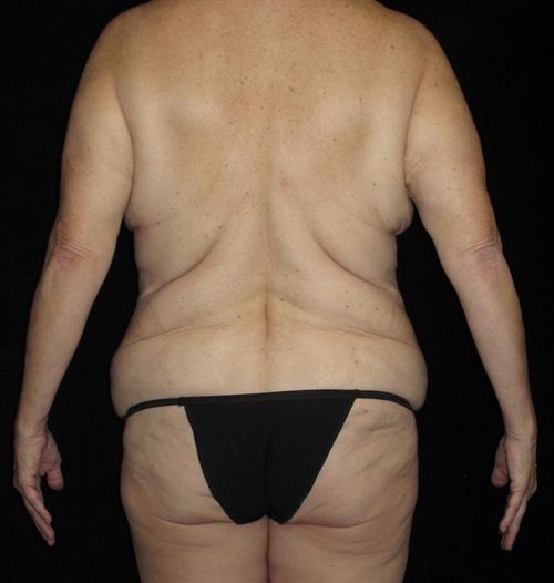 Body Lift Patient Photo - Case 188 - before view-3