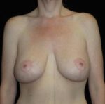 Breast Lift - Case 127 - After