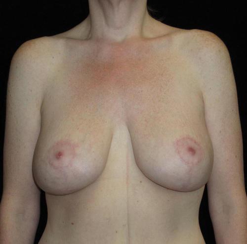 Breast Lift Patient Photo - Case 127 - after view