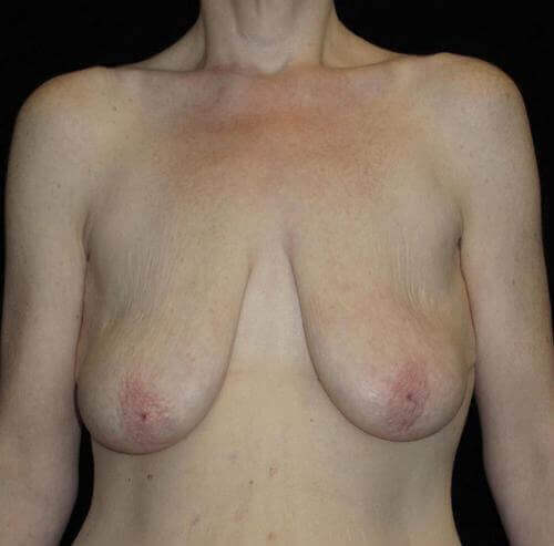 Breast Lift Patient Photo - Case 127 - before view-